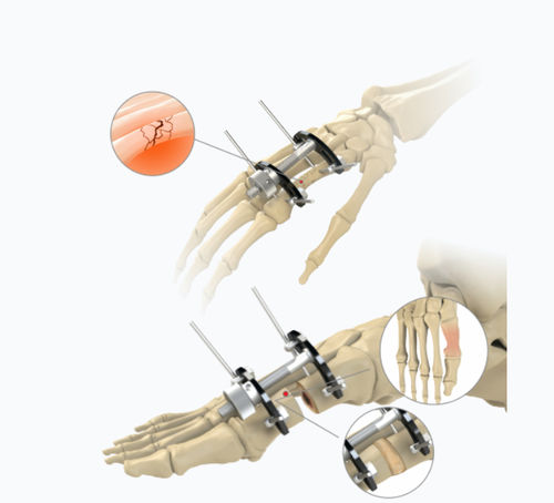 Fijador externo para articulación metacarpofalángica - 5784-0000	 - Zimed Medical - para articulación metatarsofalángica / híbrido / para adulto