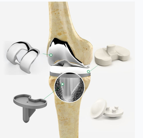 Prótesis de rodilla tricompartimental - Zimed Medical - de platillo móvil / cementada / derecha