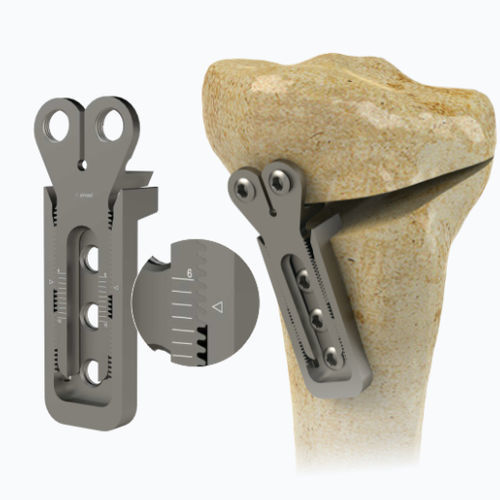 Placa de osteotomía para tibia - 1972-0016 - Zimed Medical - bloqueada / metálica