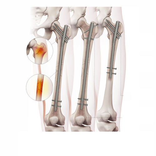 Clavo intramedular para fémur - 4602-0918 - Zimed Medical - fijación proximal / fijación distal / derecho