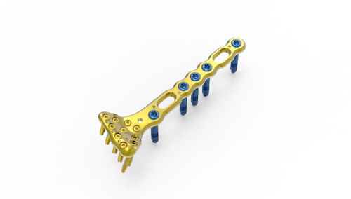 Placa de compresión para muñeca - TRUE LOCK  - Truemed Medical - porción distal / bloqueada / metálica