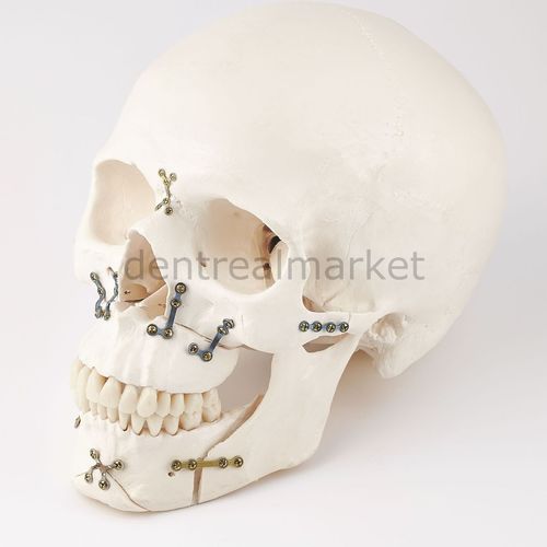 Placa de compresión para macizo facial - 56.10.116A-6 - Anka Tıbbi Malzemeler - metálica