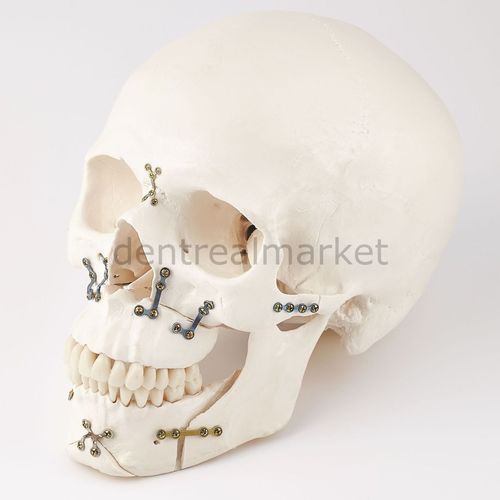 Placa de compresión para macizo facial - 56.10.116A - Anka Tıbbi Malzemeler - metálica