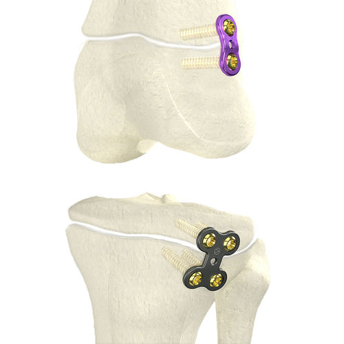 Placa de osteotomía para fémur - WishFIX™ - WishBone Medical - para tibia / porción proximal / porción distal