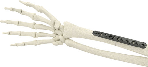 Placa de compresión para radio - PK-SCP2704-TI - WishBone Medical - porción medial / metálica / pediátrica