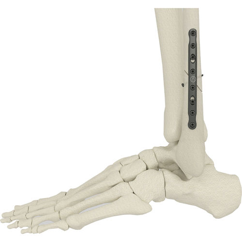 Placa de osteotomía para peroné - PK-SFP series - WishBone Medical - porción medial / no bloqueada / metálica