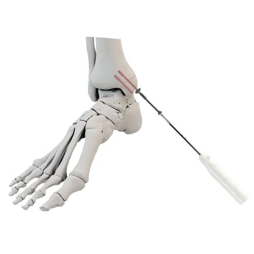 Tornillo de artrodesis para maléolo - WishBone Medical - canulado / de titanio / cortical