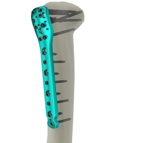 Placa de compresión para húmero - 10-2200 series - WishBone Medical - porción proximal / bloqueada