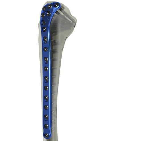 Placa de compresión para tibia - WishBone Medical - porción proximal / bloqueada / de titanio