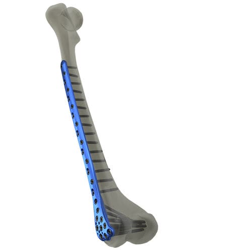 Placa de compresión para fémur - WishBone Medical - porción distal / bloqueada / de titanio