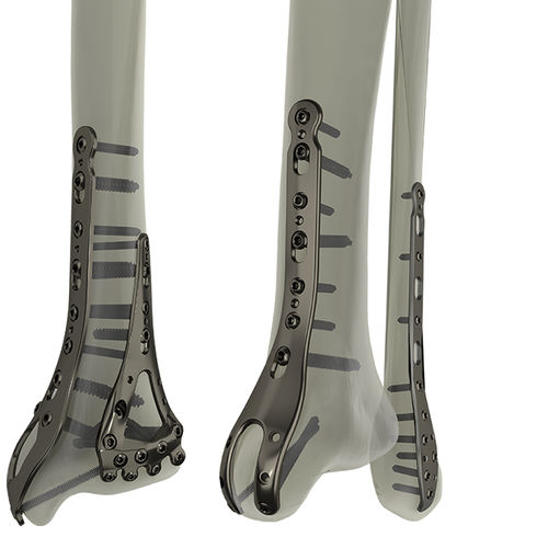 Placa de compresión para tibia - STEP®  - WishBone Medical - para peroné / para maléolo / porción distal