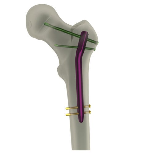 Clavo intramedular para fémur - PediFIN® - WishBone Medical - fijación proximal / pediátrico