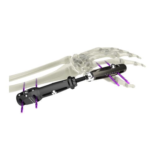 Fijador externo para muñeca - UniX® - WishBone Medical - para radio / tubular / para adulto