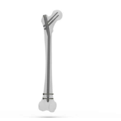 Clavo intramedular para fémur - FN2 series - TASARIMMED - fijación proximal / fijación distal / derecho