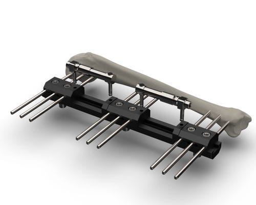 Fijador externo para húmero - TF-ERS - TASARIMMED - tubular / para adulto
