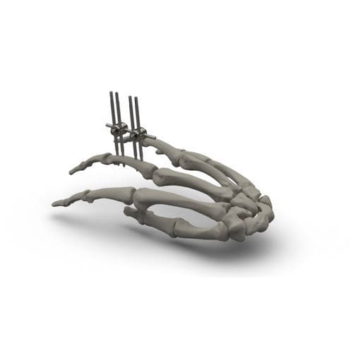 Fijador externo modular - TASARIMMED - para articulación metacarpofalángica / tubular / para adulto