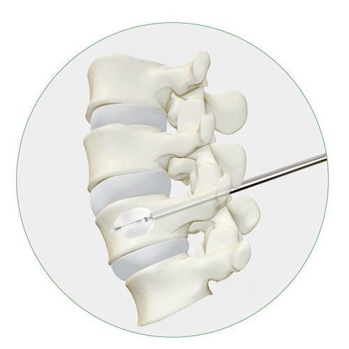 Sistema de aumento vertebral globo - Princeton Medical Scientific - para cifoplastia percutánea