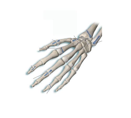 Tornillo de compresión ósea para metacarpo - Delphos Implants - para falange de la mano / sin cabeza / metálico