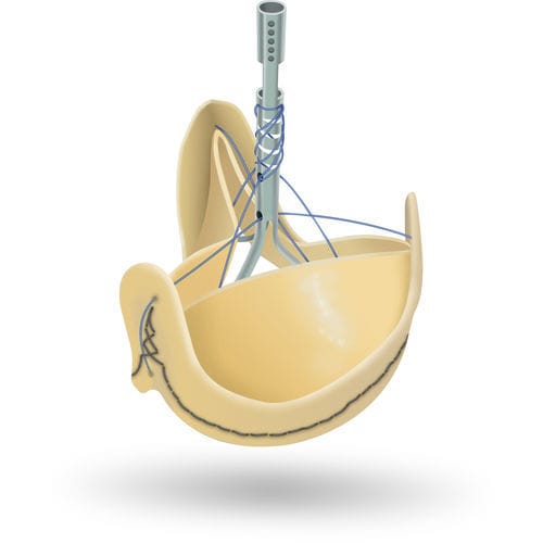 Bioprótesis valvular aórtica - SOLO SMART™ - Corcym - de tejido bovino