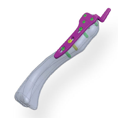 Placa de osteotomía articulación acromioclavicular - Invamed - porción proximal / bloqueada / metálica