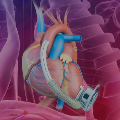 Dispositivo de asistencia ventricular para adulto - CH-VAD® - Suzhou Tongxin Medical Equipment Co., Ltd.