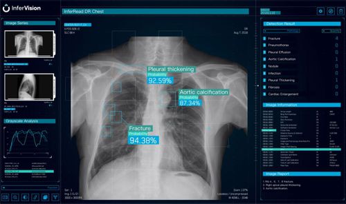 Software de análisis - DR Chest - Beijing Infervision Technology Co. Ltd. - de visualización / para informes / médico