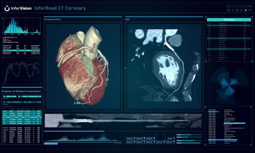 Software médico - InferRead® - Beijing Infervision Technology Co. Ltd. - TDM / de análisis / de gestión de datos