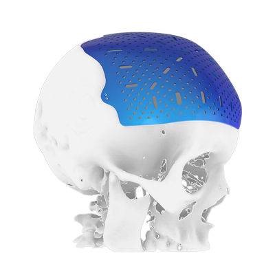 Implante craneal a medida - Osteophoenix