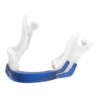 Placa de compresión para mandíbula - Osteophoenix - para macizo facial / de titanio