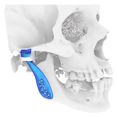 Implante temporomandibular a medida - Osteophoenix