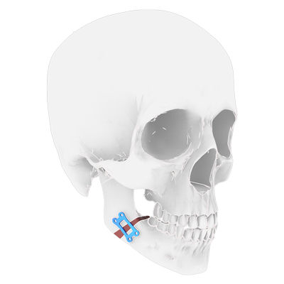 Placa de osteotomía para mandíbula - Osteophoenix - de titanio