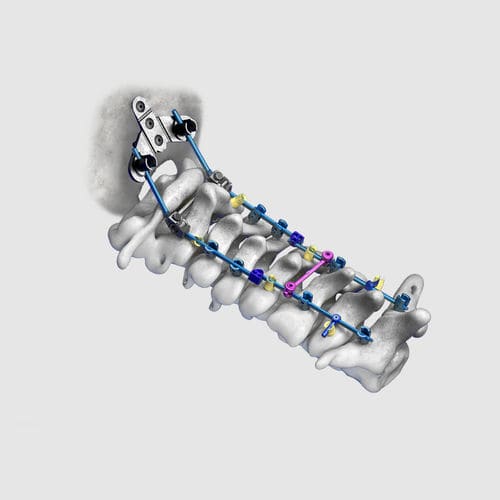 Sistema de osteosíntesis occipitocervical - Wuxi Betta Medical Technology - vía posterior / para adulto