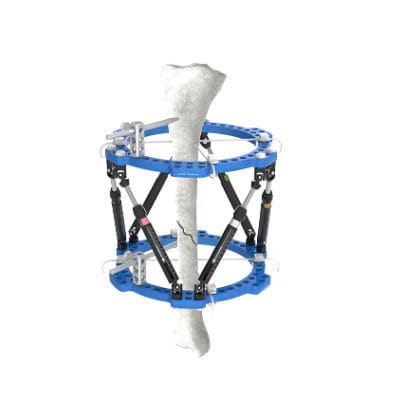 Fijador externo para tibia - Wuxi Betta Medical Technology - para tobillo / circular / para adulto