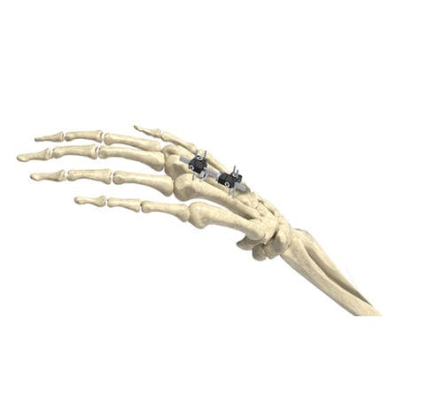 Fijador externo para articulación metacarpofalángica - Wuxi Betta Medical Technology - tubular / para adulto