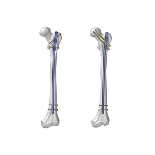 Clavo intramedular para fémur - KTO - Kangli Medical - fijación proximal / fijación distal / de titanio