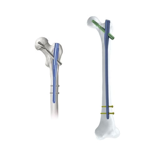 Clavo intramedular para fémur - KTO PFNA - Kangli Medical - para trocánter / fijación proximal / de titanio