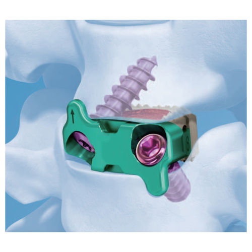 Caja intersomática cervical - G-58020 - Kangli Medical - vía anterior / de PEEK