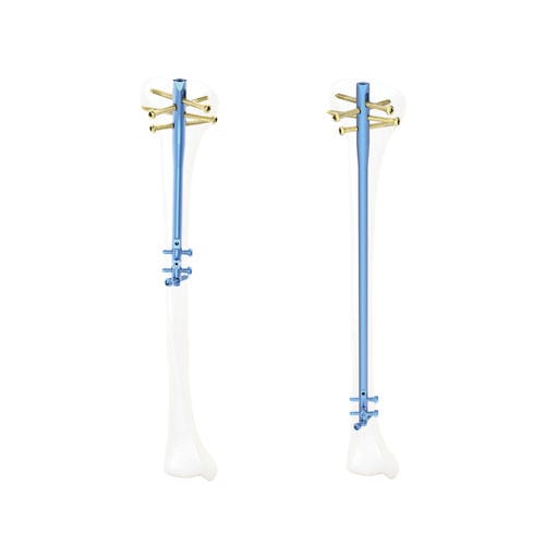 Clavo intramedular para tibia - QML - Kangli Medical - de titanio