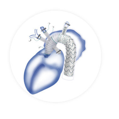 Stent-injerto arco aórtico - Fontus™ - Endovastec - de nitinol / de polietileno