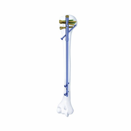 Clavo intramedular para húmero - SHGK - Chongqing FWS Medical Device - fijación proximal / fijación diafisaria / metálico