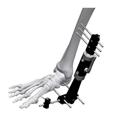 Fijador externo para tobillo - FE8M-D050   - Chongqing FWS Medical Device - tubular / para adulto