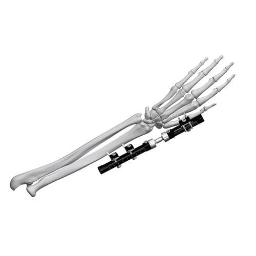 Fijador externo para muñeca - FE5M-D030  - Chongqing FWS Medical Device - tubular / para adulto