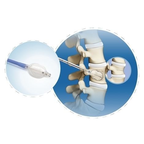 Kit de instrumentos para cifoplastia percutánea - FWS-007 series - Chongqing FWS Medical Device
