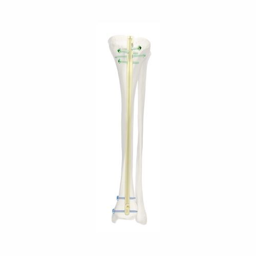 Clavo intramedular para tibia - SJGK - Chongqing FWS Medical Device