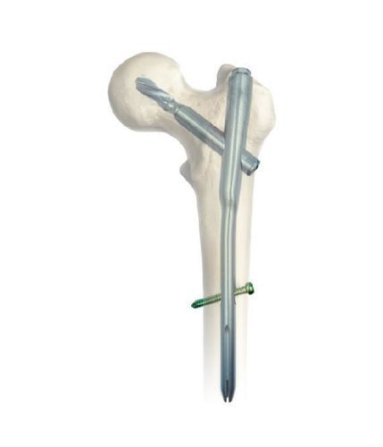 Clavo intramedular para fémur - SGM - Chongqing FWS Medical Device - fijación proximal / de titanio