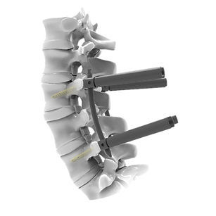 Sistema de osteosíntesis lumbar - CTS 5.5 MIS - Mediox - vía posterior / para adulto