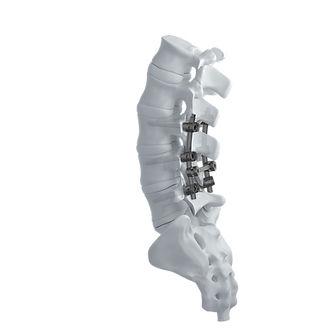 Sistema de osteosíntesis lumbar - CTS 5.5 - Mediox - vía posterior / para adulto