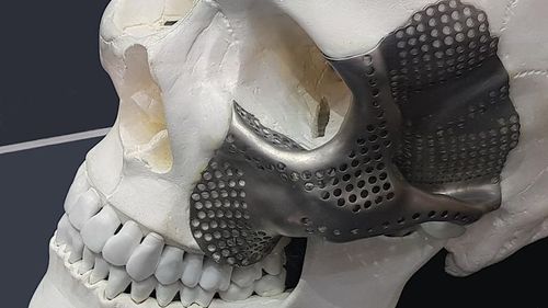 Implante periorbital a medida - OrthoCMF - Orthoscape - no reabsorbible
