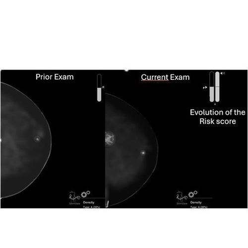 software para detección del cáncer de mama - Hera-MI