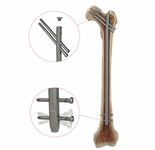 Clavo intramedular para fémur - AS.AFN.400 - Ases Orthopedics - fijación proximal / fijación distal / derecho